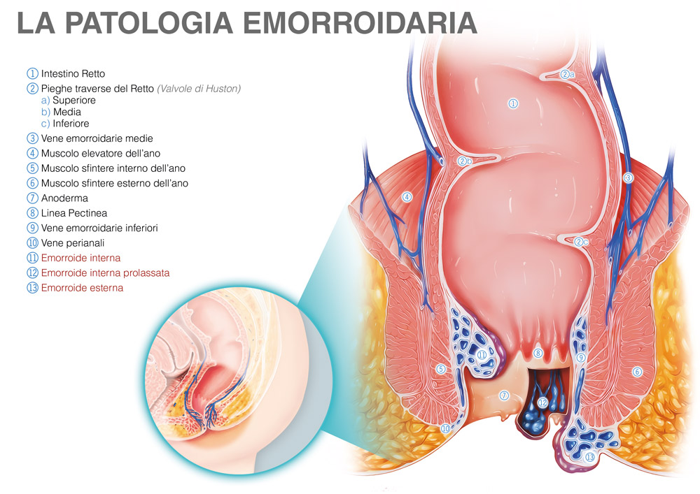 La patologia emorroidaria-4